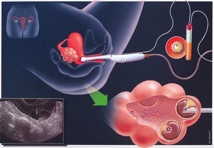 Η λαπαροσκοπική μέθοδος δεν χρησιμοποιείται πλέον για τη λήψη ωαρίων από τις ωοθήκες, αντ αυτής δε οι ιατροί χρησιμοποιούν τη διακολπική ανάκτηση ωοκυττάρων, όπου με τη χρησιμοποίηση υπερήχων