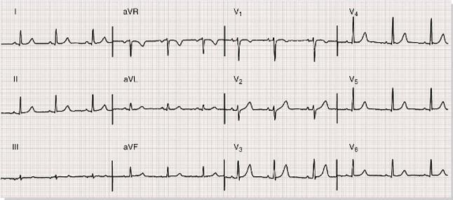 Ηλεκτροκαρδιογράφημα (ΗΚΓ) Καταγραφή καρδιακής ηλεκτρικής