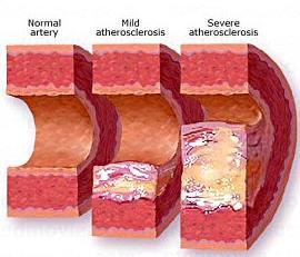 Στεφανιαία νόσος: ορισμός Ύπαρξη στένωσης των στεφανιαίων αρτηριών που παρεμποδίζει την επαρκή παροχή αίματος στον καρδιακό μυ.