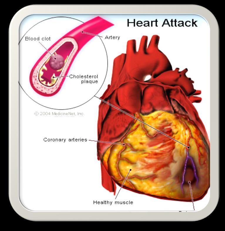 Έμφραγμα μυοκαρδίου Δυναμική διαδικασία όπου μια ή περισσότερες περιοχές του καρδιακού μυός υφίστανται απότομα σοβαρή