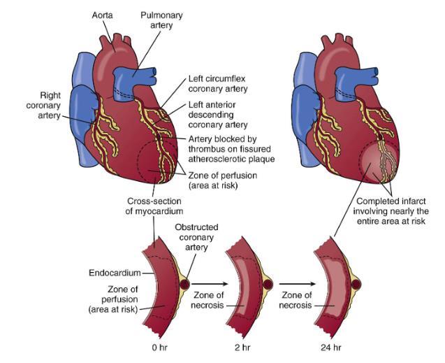 Έκταση εμφράγματος μυοκαρδίου Ζώνη νέκρωσης Θάνατος καρδιακού μυός που προκαλείται από εκτεταμένη και πλήρη στέρηση οξυγόνου με μη αναστρέψιμη βλάβη.