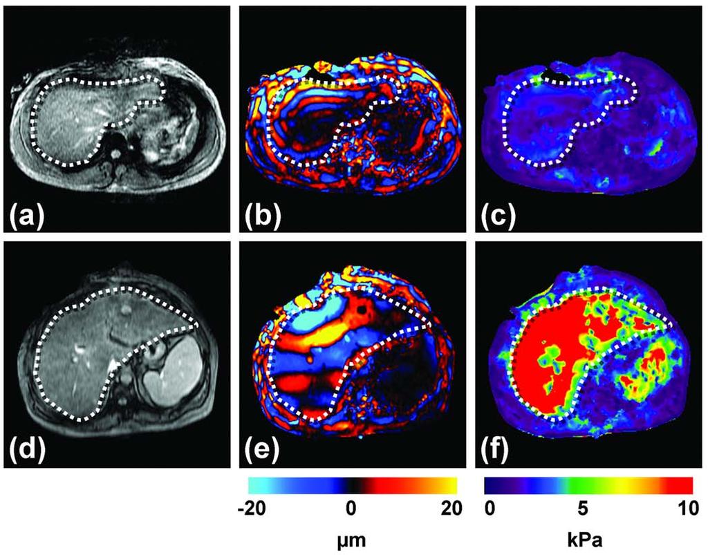 Εικόνα 17 ΗΠΑΤΙΚΗ MRE(345) Οι εικόνες απεικονίζουν MRE εξέταση ενός φυσιολογικού ήπατος (Εικόνες: a, b, c) και ενός κιρρωτικού ήπατος (Εικόνες: d, e, f).