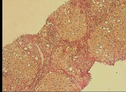 Εικόνα 3: Περιαγγειακή ίνωση σε NAFLD.