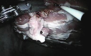 Lin L M. The development of robot-assisted minimally invasive surgery[j]. China Medical Device Information, 3, 9(2): 16-18. [2] Dankelman J.