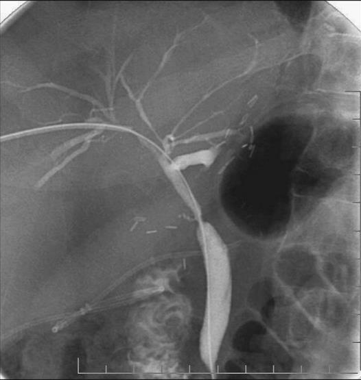 ERCP : ΛΟΙΜΩΞΕΙΣ ΧΟΛΑΓΓΕΙΙΤΙΔΑ 0,5 3% μετά ERCP χολαγγειίτιδα ( ΑSGE.