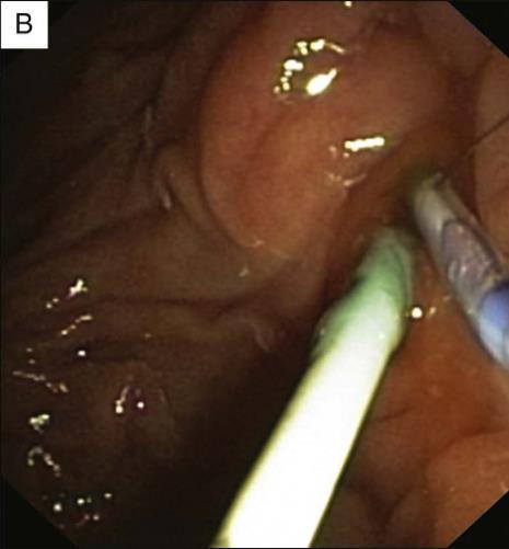 αιμάτωμα ( Endoscopy 2004;36:1019-21 ) Ενσφήνωση