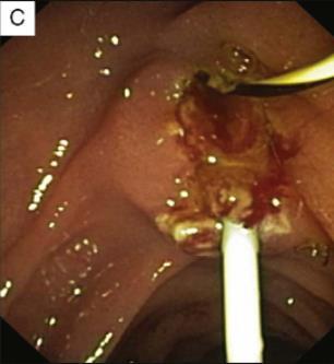 Endoscopy 2014;16:195-201 ) Eπιπλοκές
