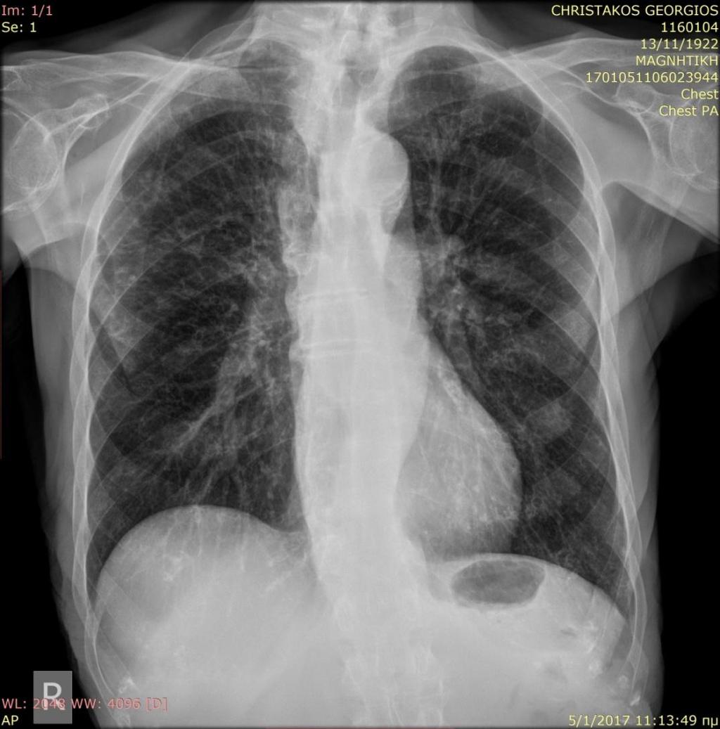 M.abscessus