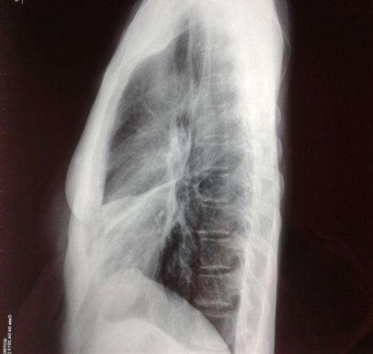avium complex pulmonary disease presenting as an