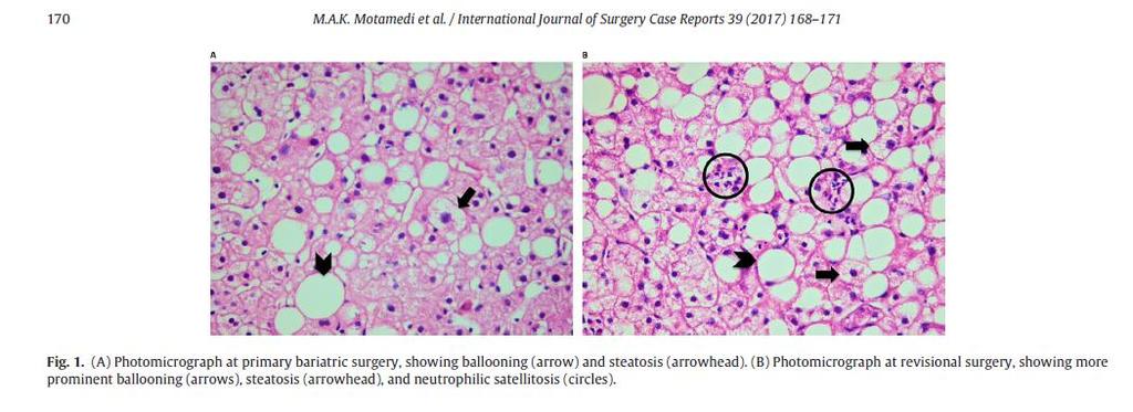 Biopsy-proven progressive fatty liver disease nine