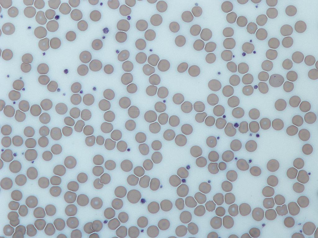 Image from a light microscope (500 ) from a Giemsa-stained peripheral blood