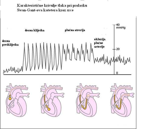 21 Karakterističan izgled krivulja pri prolasku plućnog katetera kroz srce Tlak u plućnoj arteriji (PAP): 15 30 mmhg sistola /5 12 mmhg