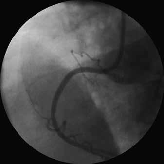 Συνίσταται η απευθείας τοποθέτηση stent στο σημείο πύλης εισόδου του διαχωρισμού