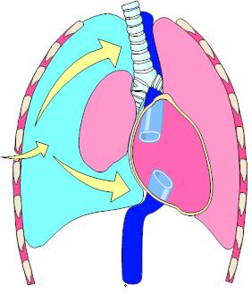Πνευμοθώρακας υπό Τάση Ελέγξτε τη θέση του ενδοτραχειακού σωλήνα σε διασωληνωμένους ασθενείς Κλινικά σημεία - Μείωση