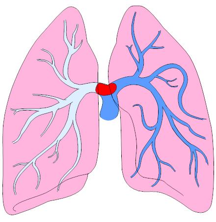 Θρόμβωση στεφανιαίων - πνευμονικών Σε υψηλή κλινική υποψία πνευμονικής εμβολής σκεφτείτε τη θρομβόλυση