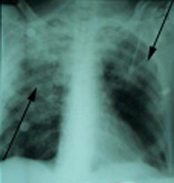 Αναπνευστική ανεπάρκεια οφειλόμενη σε μετάγγιση (transfusion related acute lung injury, TRALΙ syndrome) Συμπτώματα Πυρετός, υπόταση, ταχύπνοια, δύσπνοια, 1-6 ώρες μετά τη μετάγγιση