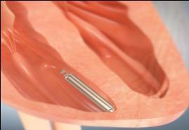 Νέες Τεχνολογίες, Τι συζητείται? (2) 4. Miniature leadless pacemakers.