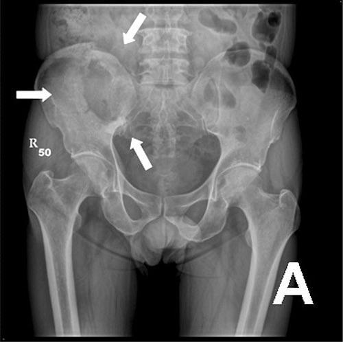 θεραπεία μεταστάσεων From 2003 to 2010, 50 prostate cancer patients were diagnosed with synchronous (n = 7) or metachronous (n = 43) oligometastases (OM).