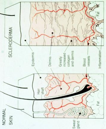 Τι παθαίνει το δέρµα στην σκληροδερµία?