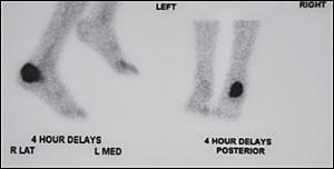 Το σπινθηρογράφημα με Τεχνήτιο (99mTc τριών φάσεων) αποτελεί χρήσιμη εξέταση για τη διάγνωση τής νόσου.