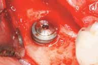 com * Refer to latest version of Simplant software with Simplant Implant Library available on www.simplantdentsply.