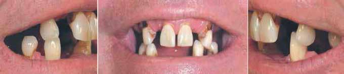 Εμφυτεύματα - Προσθετική 10 Dental Tribune Greek Edition Ακίνητες και κινητές επιεμφυτευματικές αποκαταστάσεις Μια θεραπευτική επιλογή για την άνω και κάτω γνάθο Dr. Paresh B.