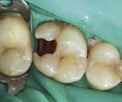 4% Dispenser Caps Απόχρωση Σύριγγα 4 g Universal REF 2595 A1 REF 2596 A2 REF 2597 A3 REF 2598 class I-II restorations 4 mm bulk fill 420% radiopacity 4 shades Caps 16 0,25 g REF 2714 REF