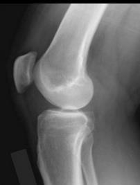 Αξιολόγηση Άρθρωση γόνατος στο κέντρο Περιφερικές αρθρικές επιφάνειες μηριαίων κονδύλων συμπροβάλλονται, κνημομηριαίος αρθικός χώρος ανοικτός Πρόσθιες
