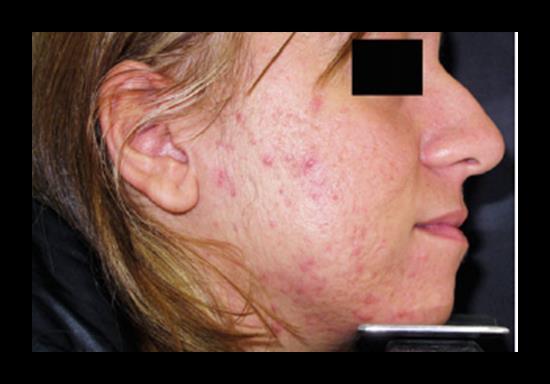 3.1.3.4. Ακμή ενηλίκων Η ακμή ενηλίκων (adult acne) μπορεί να αποτελεί συνέχεια της εφηβικής ακμής ή να εμφανιστεί εκ νέου.