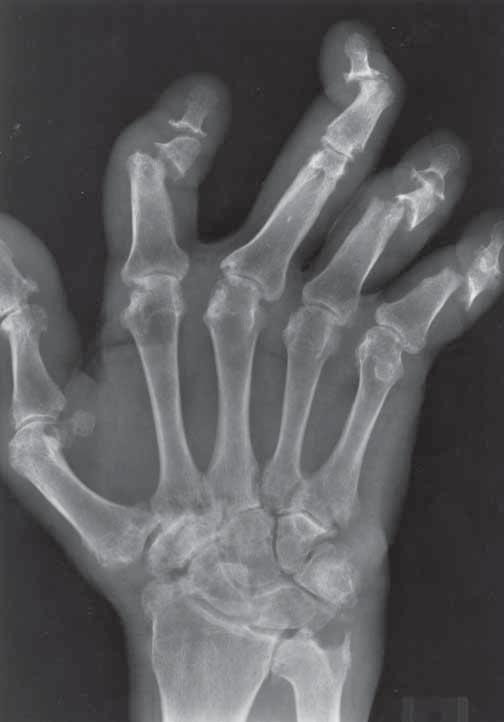 1.2 ΚΛΙΝΙΚΟ ΙΣΤΟΡΙΚΟ Άνδρας 55 ετών με εξάνθημα. ΕΙΚΟΝΑ 1.2 ΕΥΡΗΜΑΤΑ ΟΠ ακτινογραφία του δεξιού χεριού. Η πολυαρθρίτιδα κατανέμεται σε όλο το χέρι και τον καρπό.