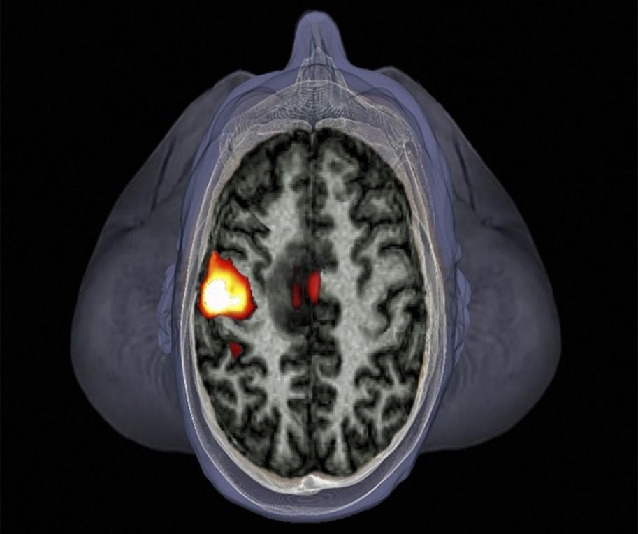Χαρτογράφηση Ανθρώπινου Εγκεφάλου Η πιο κοινή χρήση του fmri μέχρι σήμερα αποτελεί ο εντοπισμός περιοχών του εγκεφάλου που ενεργοποιούνται μετά από ερέθισμα που προκλήθηκε