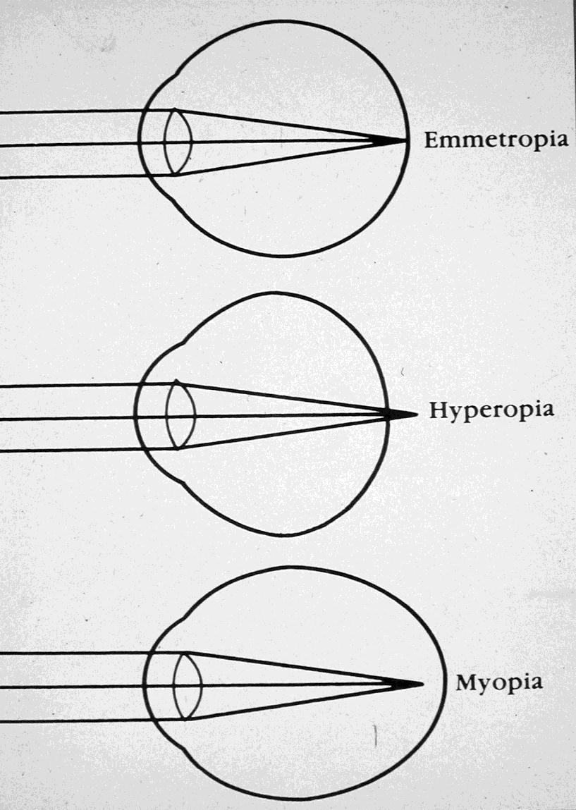 Μυωπία: Αν η καμπυλότητα του κερατοειδούς χιτώνα είναι πολύ απότομη ή το αξονικό μήκος του ματιού είναι πολύ μακρύ, το φως εστιάζεται έμπροσθεν του αμφιβληστροειδούς.