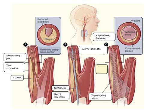 ΘΡΟΜΒΟΕΜΒΟΛΙΚΕΣ ΠΑΘΗΣΕΙΣ Εικόνα 5. Αγγειοπλαστική με stent καρωτίδας. Βιβλιογραφία Περιφερική αρτηριακή νόσος 1. Mckenna M, Wolfson S, Kuller L.
