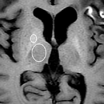 με χορήγηση Gd Dentate Nucleus on T1w
