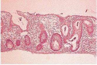 architecture Surface inflammation Neutrophil
