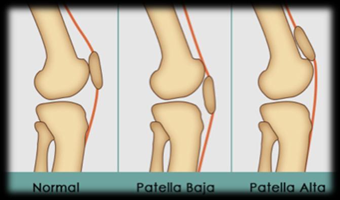 47 Εικόνα7.2: Θζςθ επιγονατίδασ (https://emergencymedicinecases.com) 7.