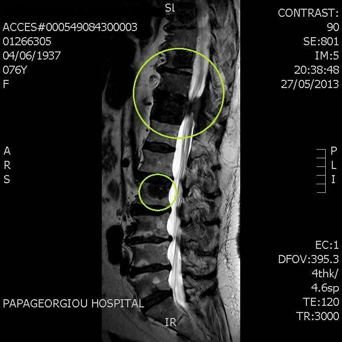 Νέα σταδιοποίηση MRI εγκεφάλου : κφ MRI ΑΜΣΣ, ΘΜΣΣ, ΟΜΣΣ: νέες meta εστίες