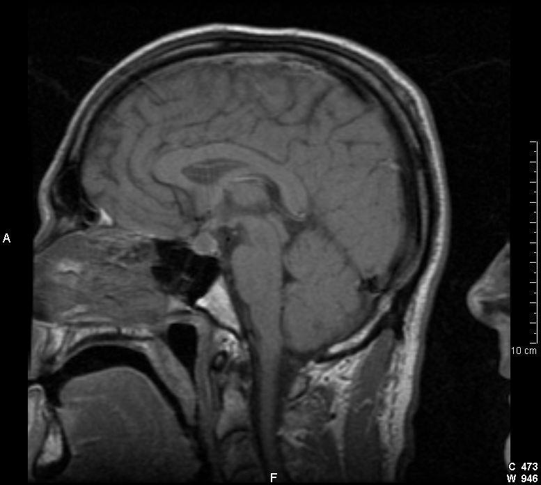 Radiographic Findings for IPIassociated