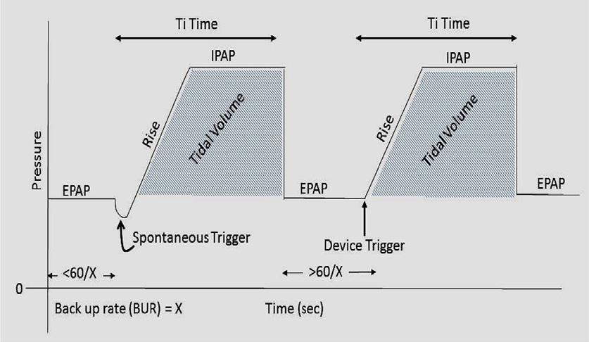 ΜΟΝΤΕΛΑ μηεμα Ελεγχόμενης πίεσης-pressure controlled ventilation PCV T mode Η συσκευή χορηγεί μια προκαθορισμένη πίεση σε κάθε εισπνοή.