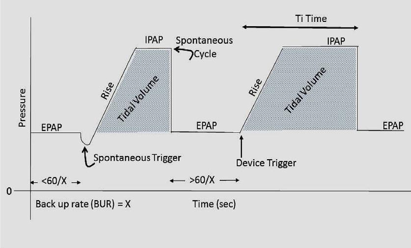 ΜΟΝΤΕΛΑ μηεμα ST mode Εναλλαγή από pressure support σε pressure control όταν δεν ανιχνεύεται