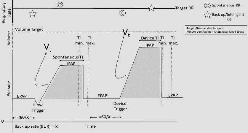 ΜΟΝΤΕΛΑ μηεμα Average volume-assured pressure support -AVAPS (Respironics) διατηρεί έναν αναπνεόμενο όγκο Vt ίσο ή μεγαλύτερο από έναν προκαθορισμένο όγκο, ρυθμίζοντας την IPAP μεταξύ μιας ελάχιστης