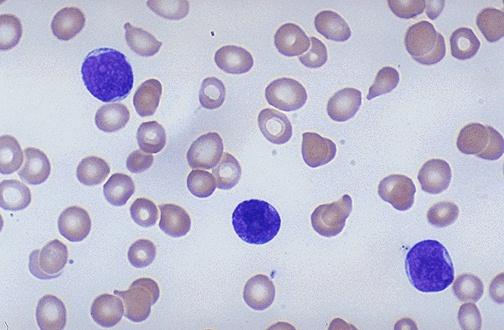 fusion protein bcr- abl fusion