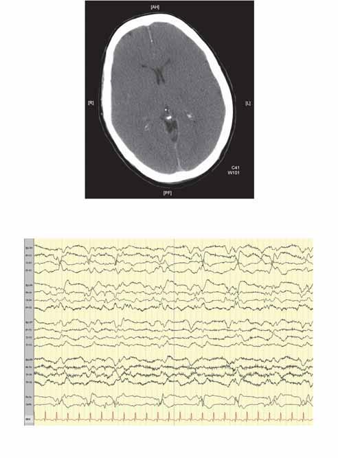 3 Υποξική Ισχαιμική Εγκεφαλοπάθεια συνέχεια Η CT του εγκεφάλου δείχνει κατάργηση του διαχωρισμού φαιάς και λευκής ουσίας.