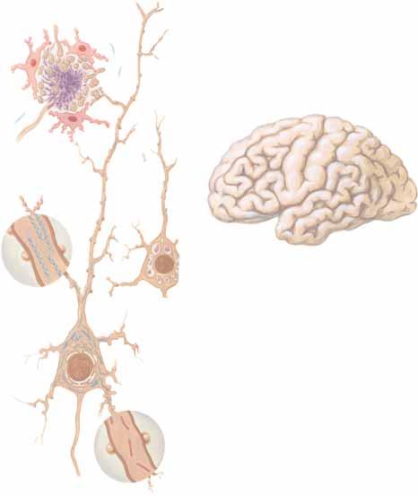 3 Νόσος Alzheimer συνέχεια Νευροπίλημα Eκφυλισμένοι νευρίτες αστροκύτταρο Ατροφία ελίκων σε περιοχές του μετωπιαίου φλοιού Πρωτεινικός πυρήνας β-αμυλοειδούς Κύτταρο γλοίας Σχετική μείωση Ατροφία στην