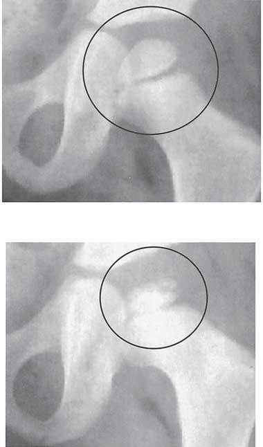 Κάτω παρεκτόπιση Αυχένας μηριαίου Μηριαία κεφαλή A Ηβικό οστό Κοτύλη Παρεκτόπιση προς τα πίσω Πρόσθια άποψη Μηριαίο Εικόνα 17-19 Επιφυσιολίσθηση τής άνω μηριαίας επίφυσης.