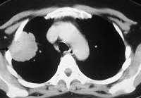 Στάδιο ΙΙΙ (Τ3-4Ν0-1) διήθηση θωρακικού τοιχώματος υποψηφιοι για χειρουργική εκτομή (curative-intent surgical resection), επεμβατική σταδιοποίηση μεσοθωρακίου εξωθωρακική απεικόνιση με CT/MRI