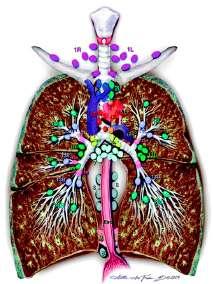 Σταδιοποίηση καρκίνου πνεύμονος Tumor Nodes
