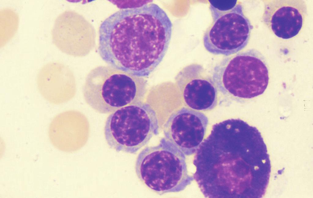 ΕΡΥΘΡΟΚΥΤΤΑΡΑ 113 Εικόνα 16. Kύτταρα της ερυθροκυτταρικής σειράς. Κάτω δεξιά παρατηρείται ένα μαστοκύτταρο (μυελός των οστών).