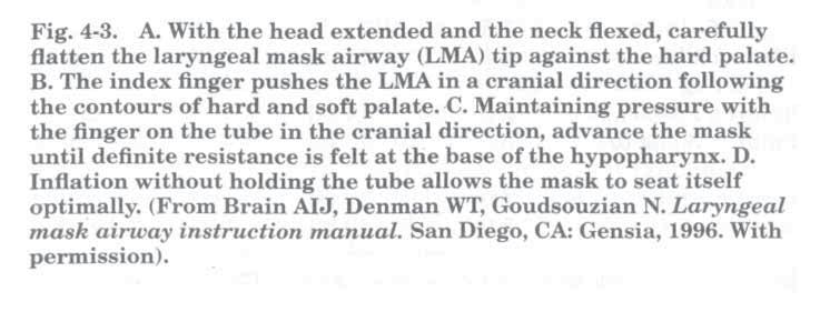 4. Διαχείριση του Αεραγωγού 73 ΑA B ΓC ΔD Εικόνα 4-3. Α. Με την κεφαλή σε έκταση και τον αυχένα σε οπίσθια κάμψη, προσεκτική είσοδο του άκρου της λαρυγγικής μάσκας (LMA) προς την σκληρή υπερώα.