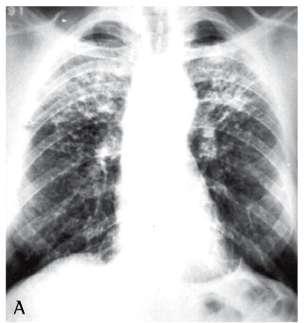 Α/α θώρακος συμβατή με παλαιά TB Σε (+) mantoux / IGRA χωρίς συμπτώματα Ζητάμε παλαιά ακτινογραφία Αναμένουμε 3 πτύελα- απλα ή προκλητά (βρογχοσκόπηση?